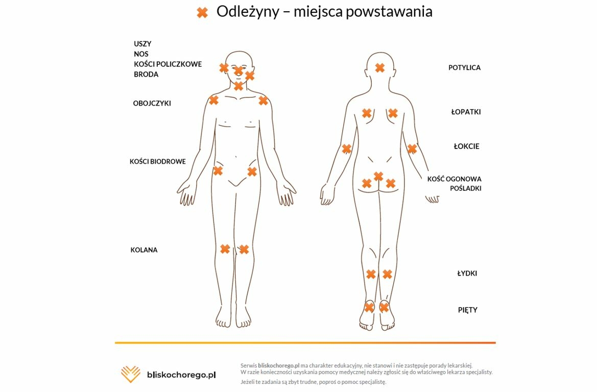 Rysunek z zaznaczonymi miejscami powstawania odleżyn u chorego
